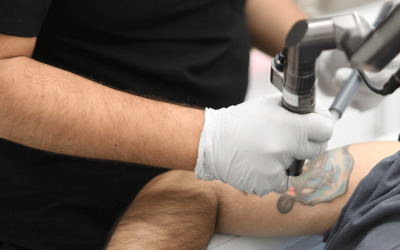 The Impact of Tattoo Colors on the Removal Process