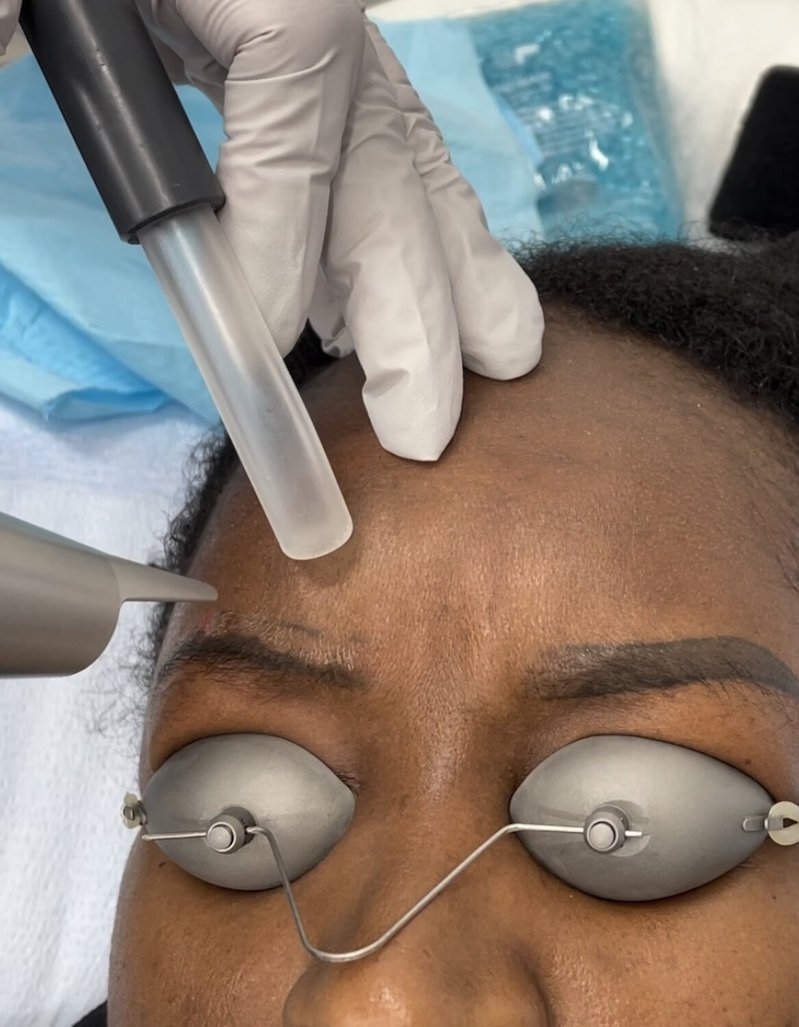 Tattoo Removal Clinic & Laser Treatments in the DMV Zapatat®️