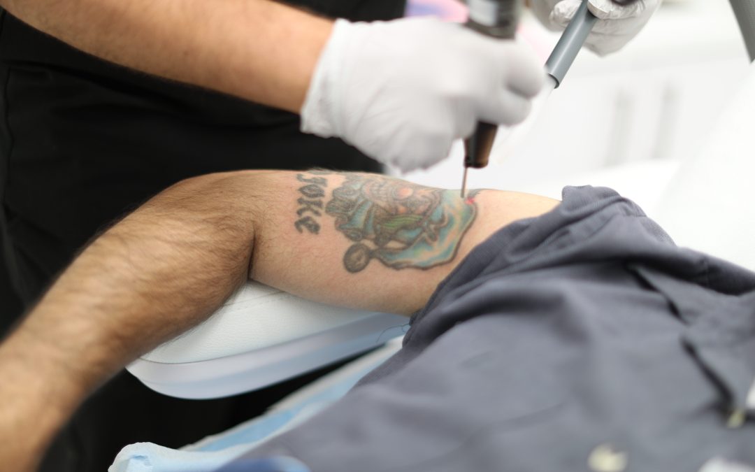 Tattoo Removal After guide
