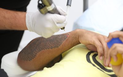 What You Need To Know About Saline Tattoo Removal