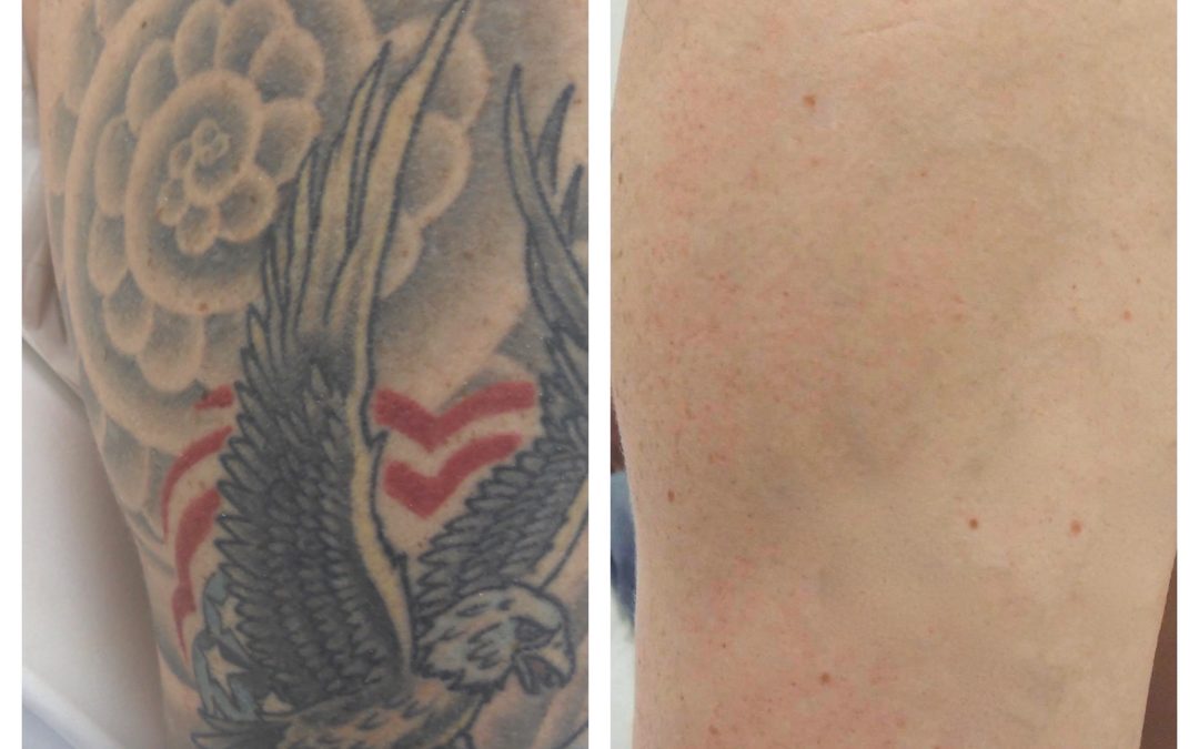 Laser Tattoo Removal vs. Accelerated Removal Technique