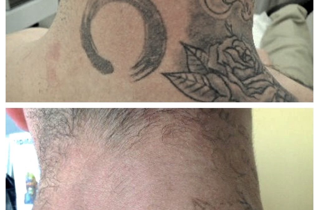 Precision and Perfection: How ART Surpasses Pico in Tattoo Removal.