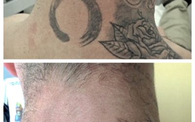 How Long To Wait Between Tattoo Removal Sessions
