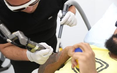 Pico Laser Tattoo Removal vs. Accelerated Removal Technique