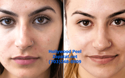 Hollywood Carbon Peel vs. Hollywood Facial: Which is Right for You?
