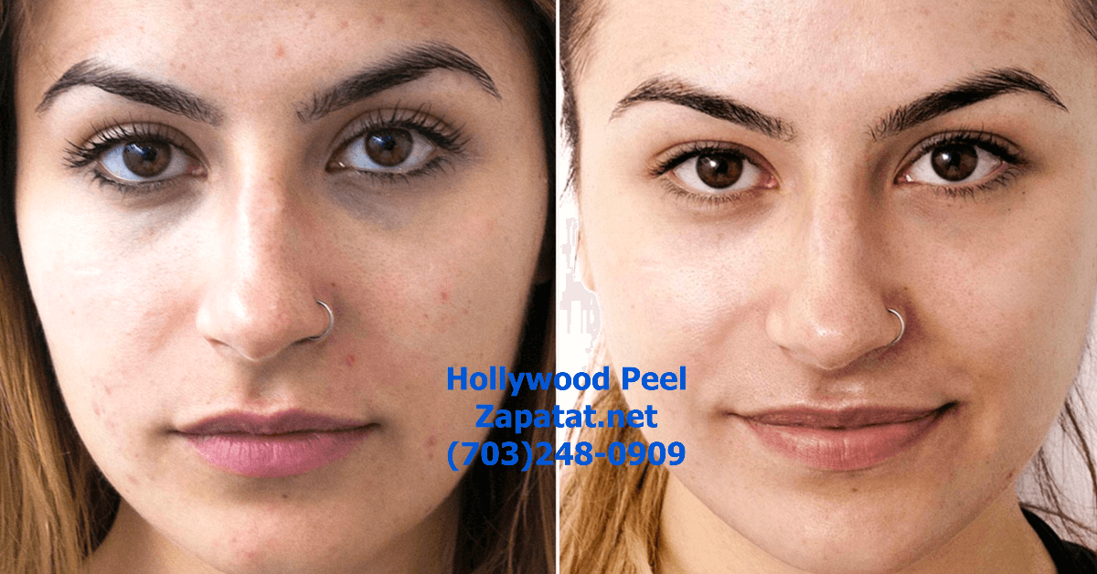 Hollywood Peel | Hollywood Carbon Peel vs. Hollywood Facial: Which is Right for You?