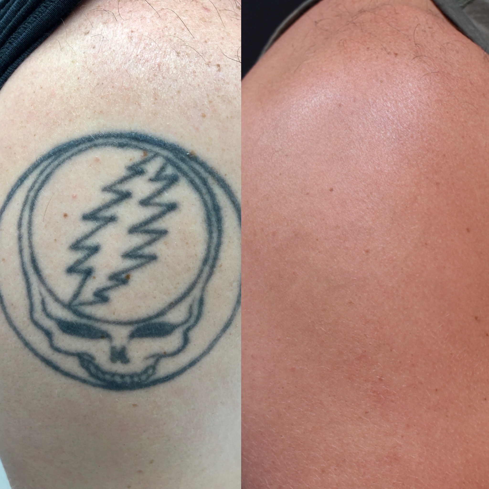 Worlds fastest tattoo removal services | Zapatat Tattoo removal