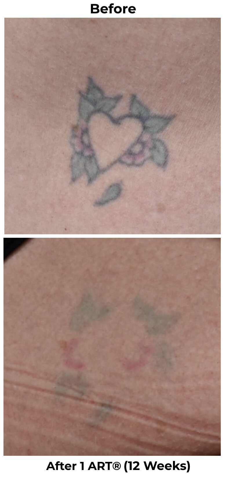 Tattoo Removal results in weeks