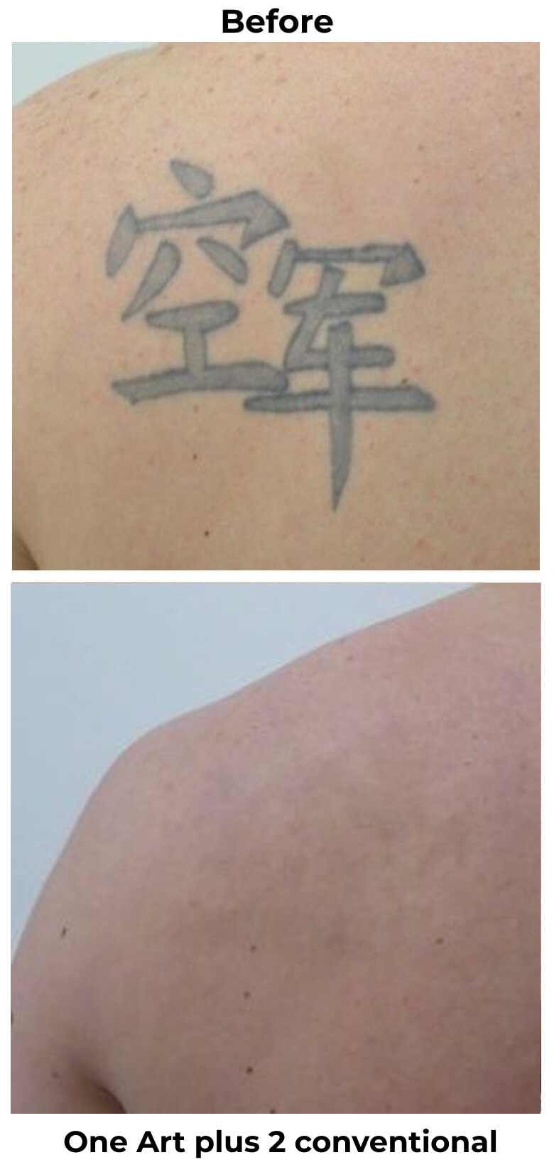 Shoulders Tattoo Removal in weeks not in years