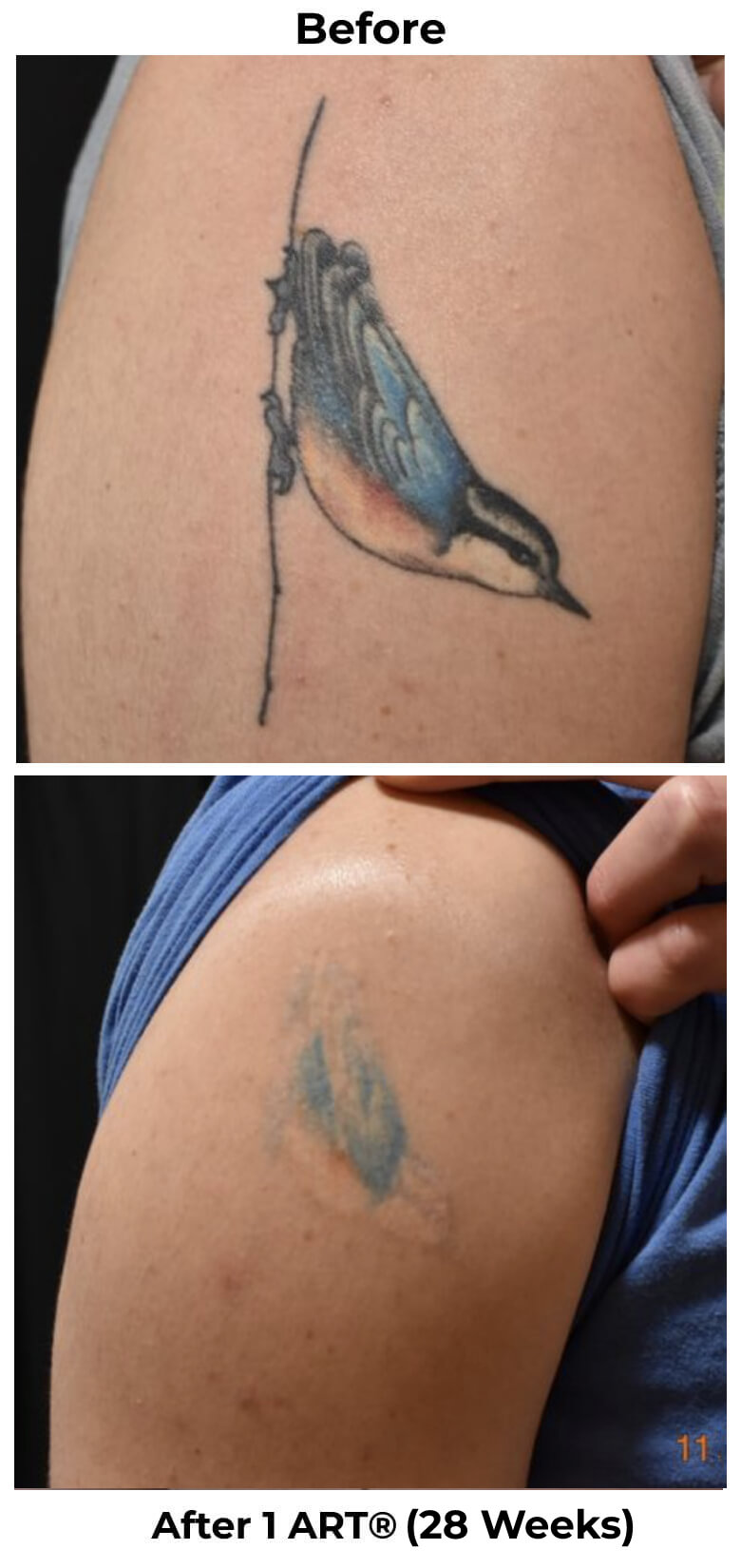 Efficient tattoo removal services