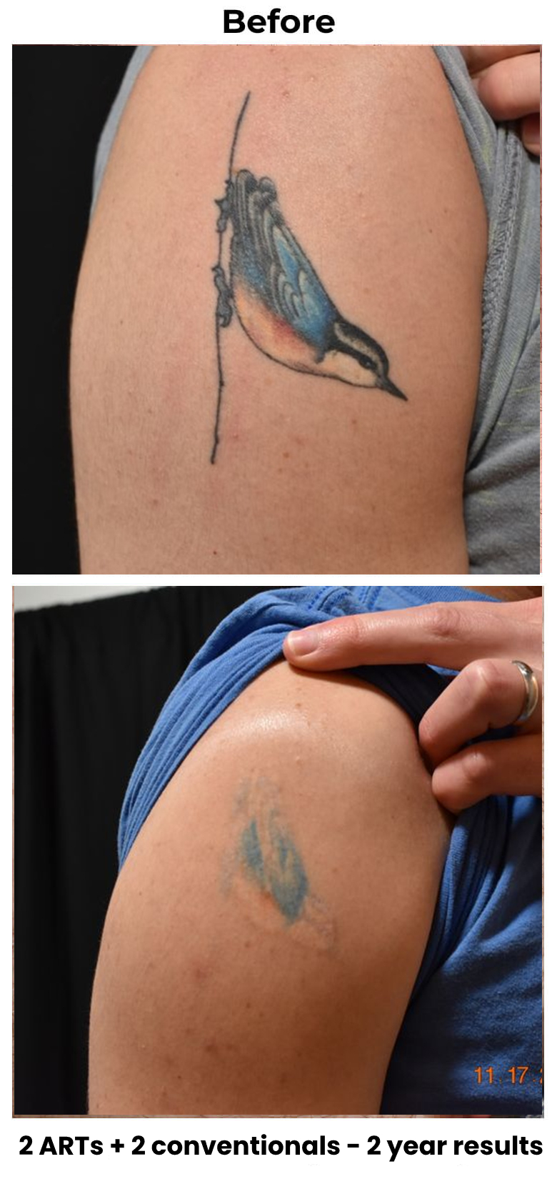 Accelerated tattoo removal treatments