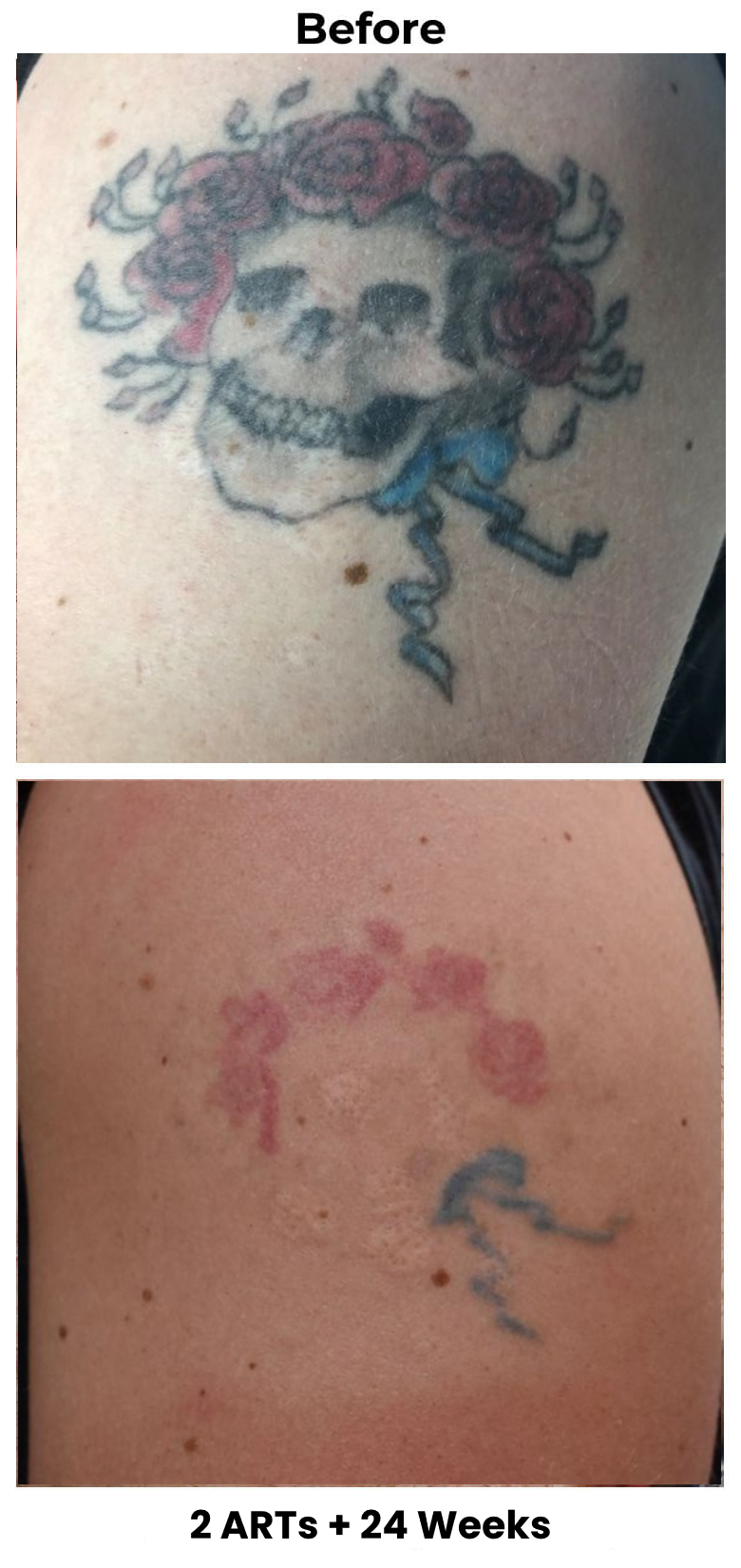  Accelerated tattoo removal treatments