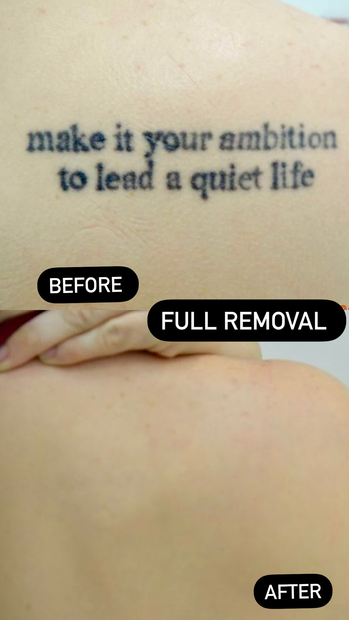 EBD5C0C5-29D9-4A1E-A99C-C64FD0A87AC2 Full tattoo removal