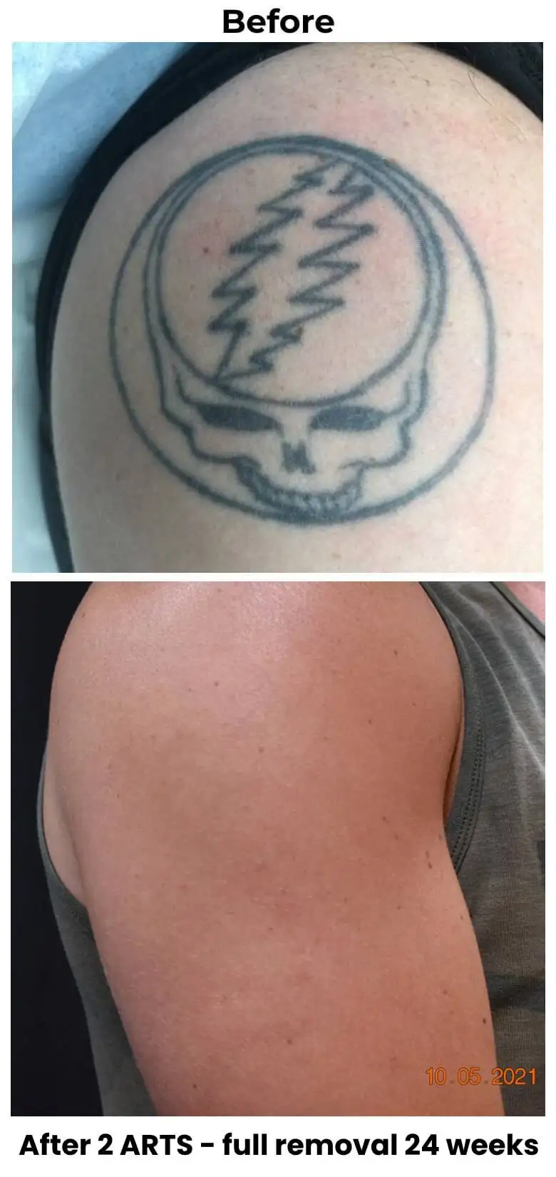 before-after- full tattoo removal