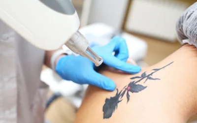 Tattoo Removal Packages: The Dirty Secrets